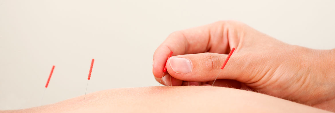 Stop Chronic Pain with Dry Needling | Therapydia NOLA